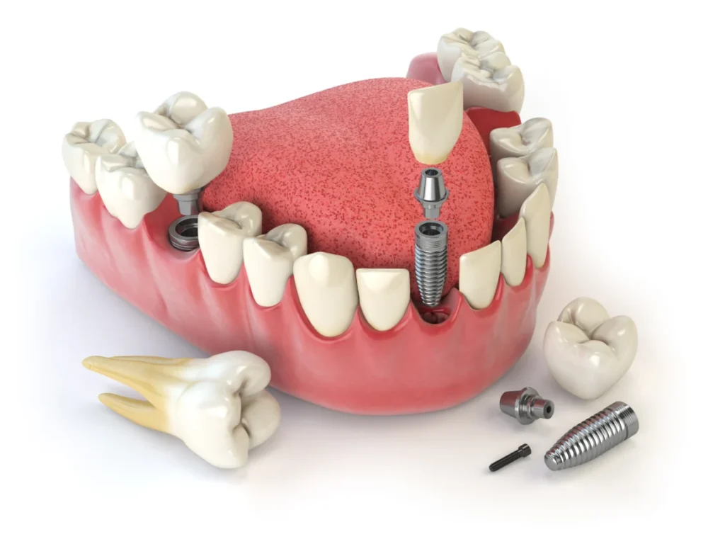Immediate vs. Delayed Dental Implants After Extraction: How Dentists Make the Call